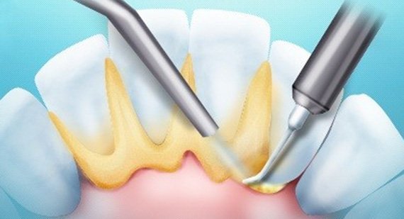 Методы удаления зубного камня